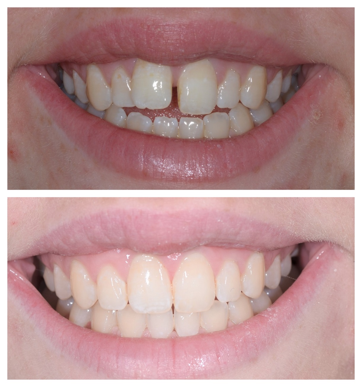 Invisalign open bite 5 Infinity Dental Clinic