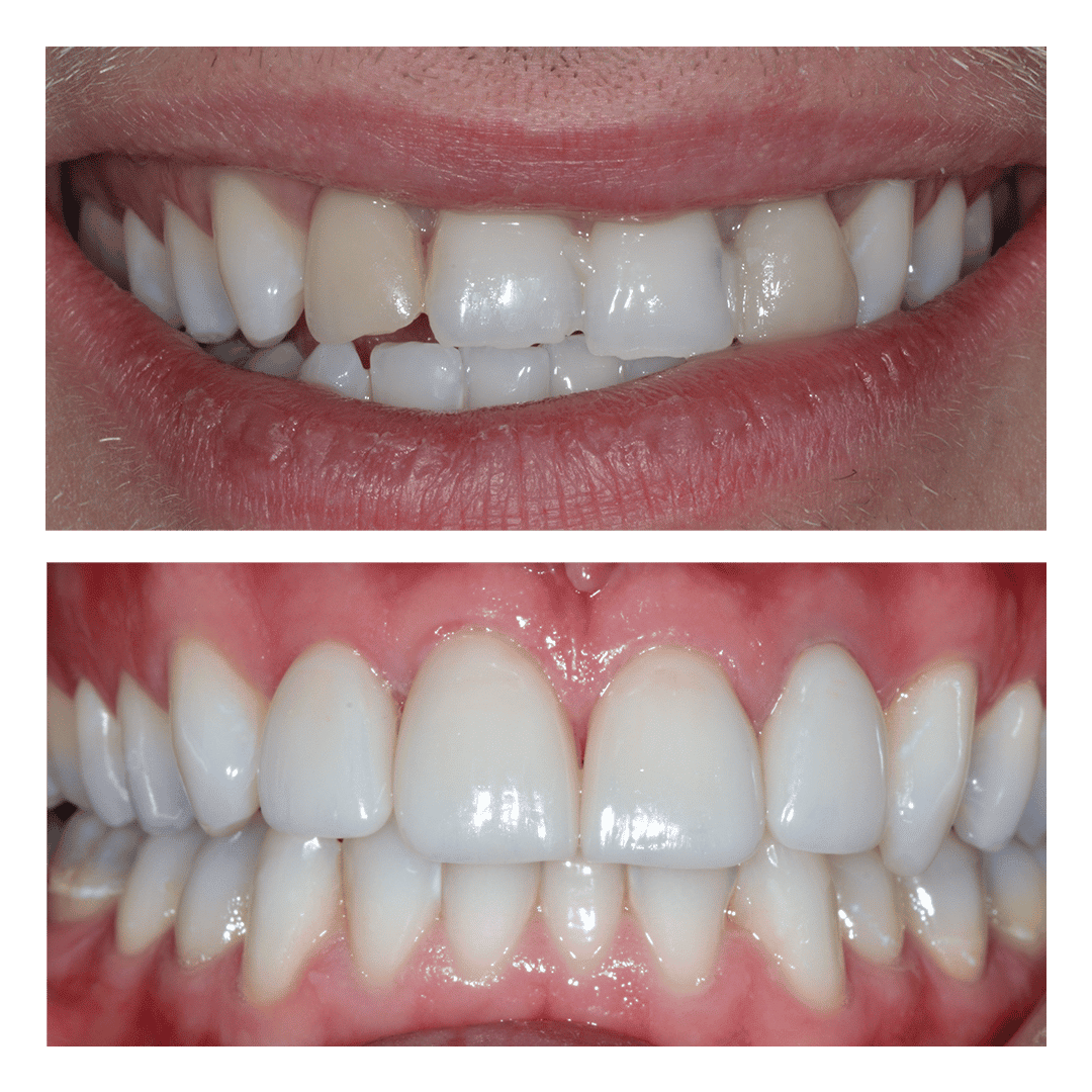 Cosmetic dentistry smile makevoer using veneers