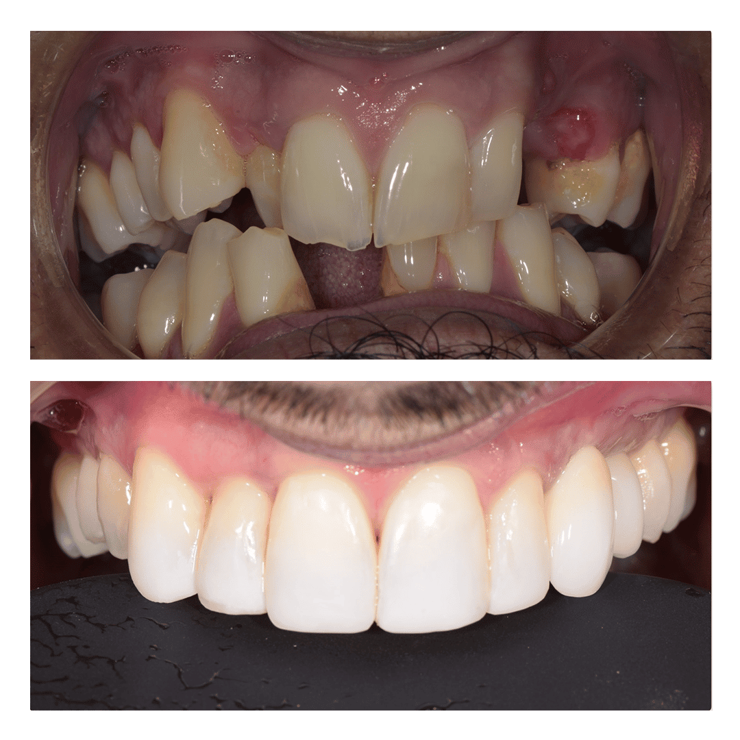 Cosmetic dentistry invisalign and dental implants