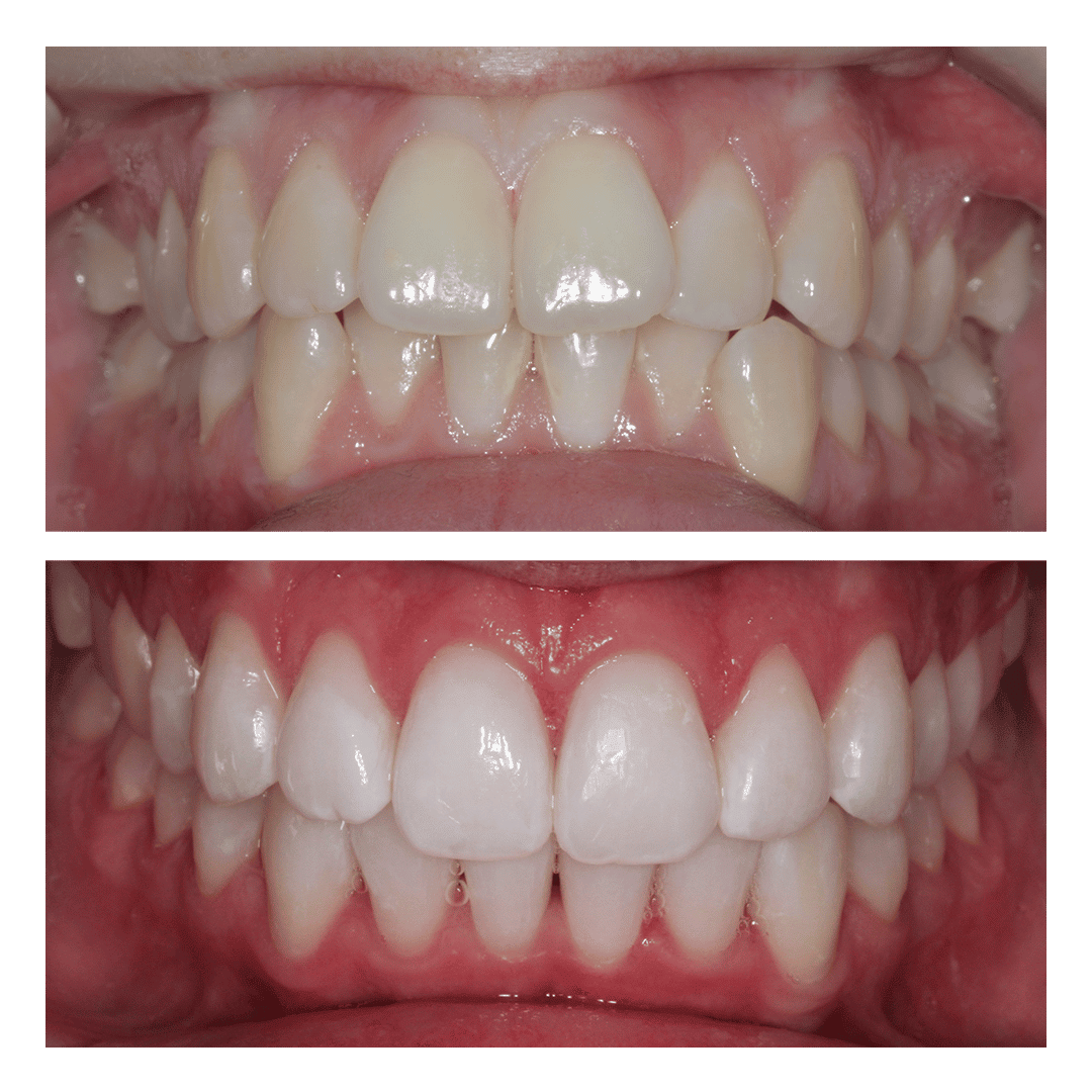 Cosmetic dentistry Invisalign and teeth whitening