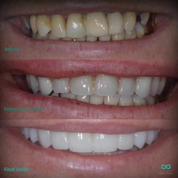 full arch same day teeth showing the 3 main stages