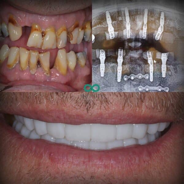 full arch same day teeth with 8 dental implants