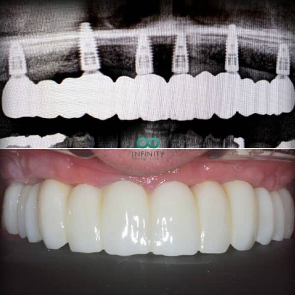 full arch same day teeth dental implants using an all on 6 approach