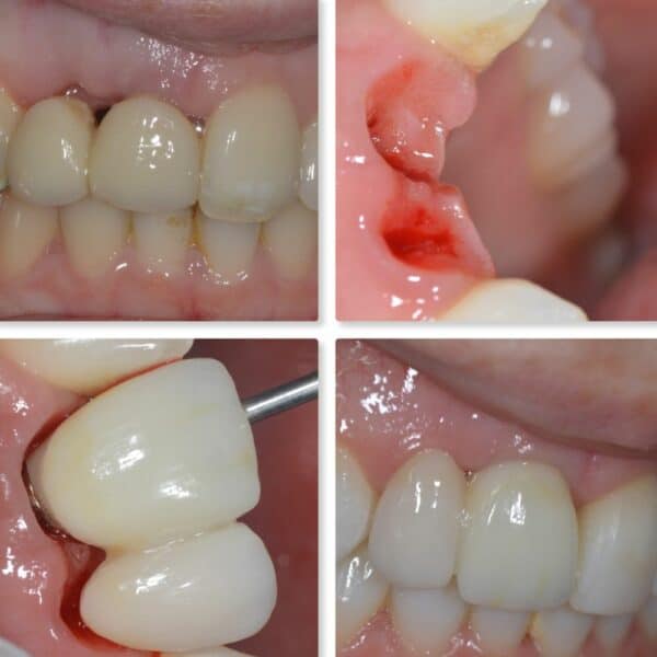 Gum Shaping with dental implant bridge