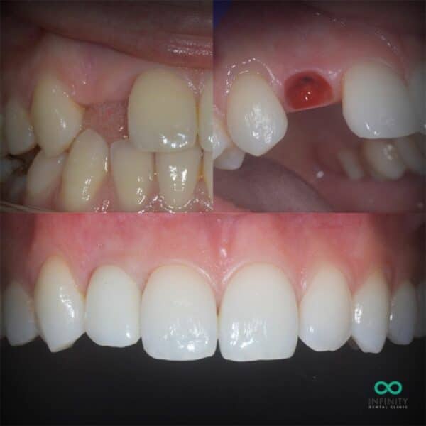 Dental implants natural gum contouring