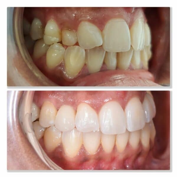 Invisalign orthodontics
