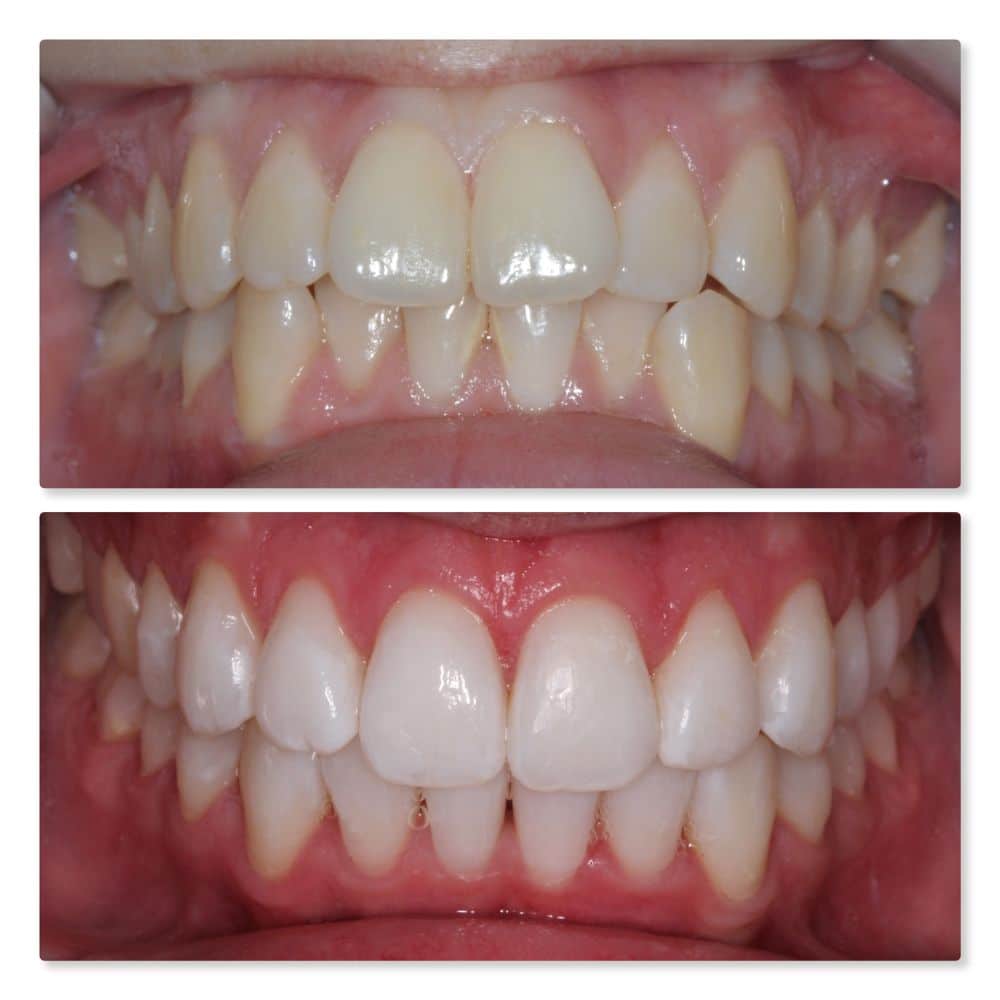 Teeth whitening and orthodontics