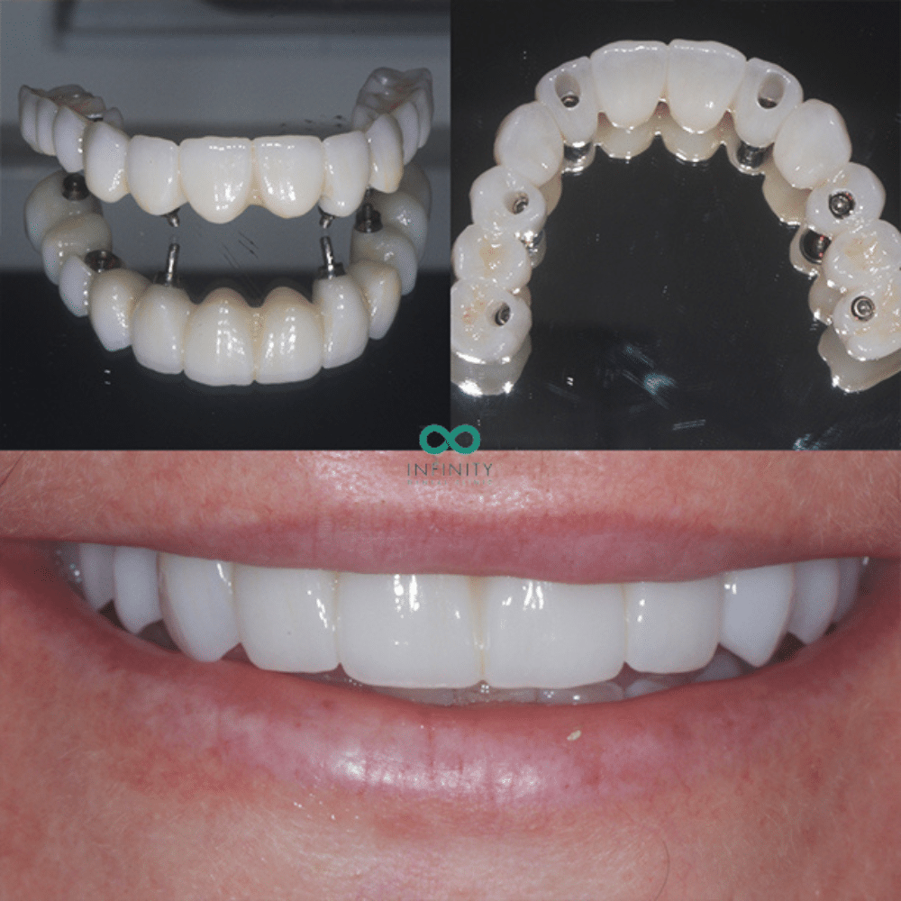 full arch same day teeth dental implants showing the fixtures and attachment screws