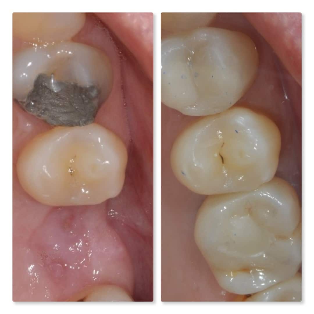 Dental implant to replace missing tooth and composite to replace amalgam silver filling