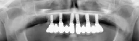 Dental implant radiograph