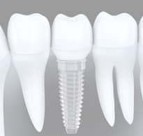 Straumann Dental Implant world leading implant system