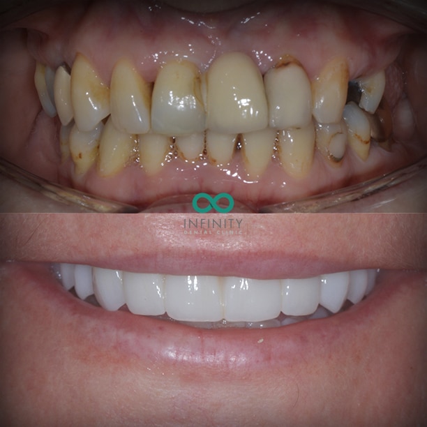 Dental implant life changing natural smile created