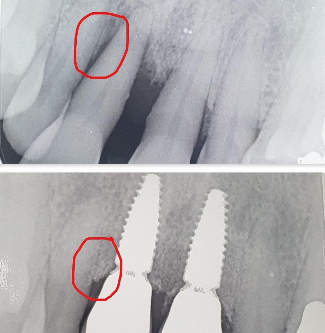 Dental implants with bone grafting