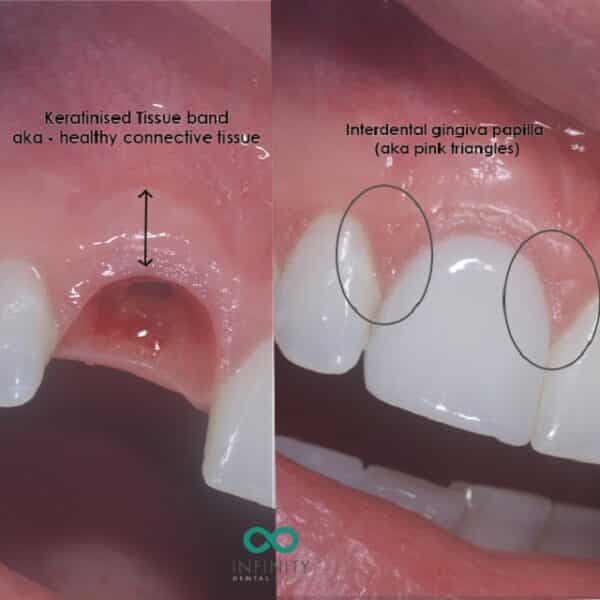 Gum shaping explained with dental implants at Infinity Dental Clinic
