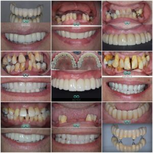 Dental implant before and after collage