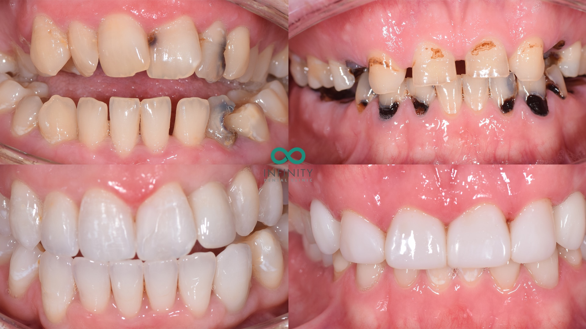 Cosmetic dentistry cases Infinity Dental Clinic
