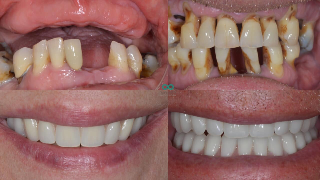 Dental implant retained denture cases
