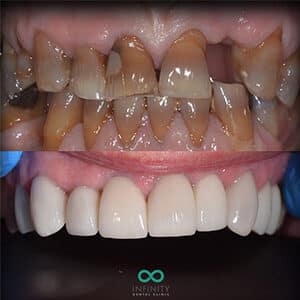 Cosmetic dentistry to improve existing smile and teeth