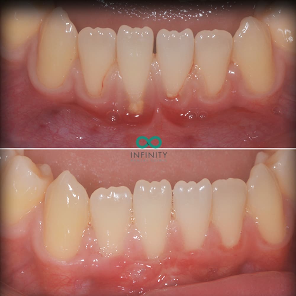 Gum graft periodontal care