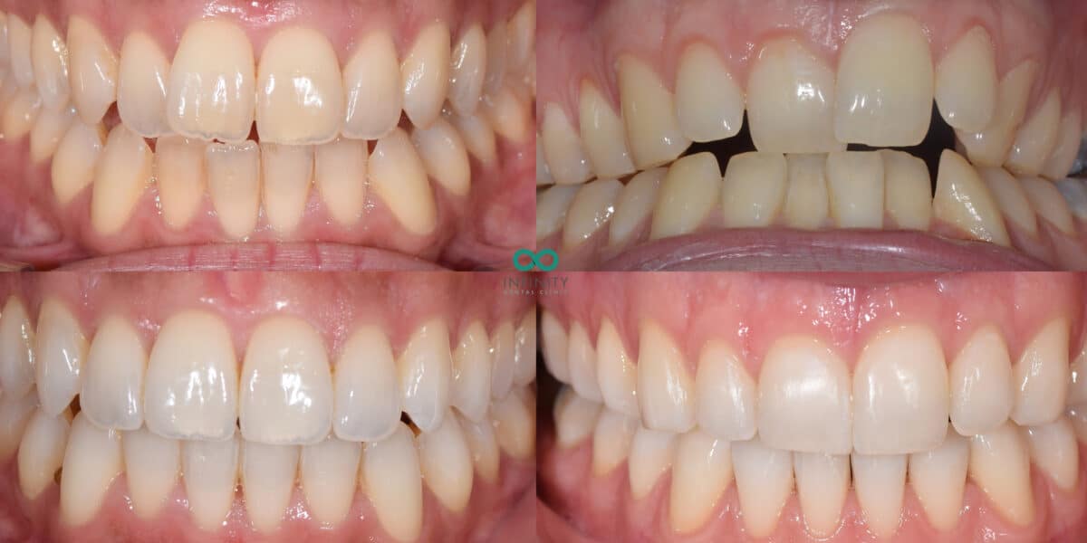 Invisalign cases at Infinity Dental Clinic