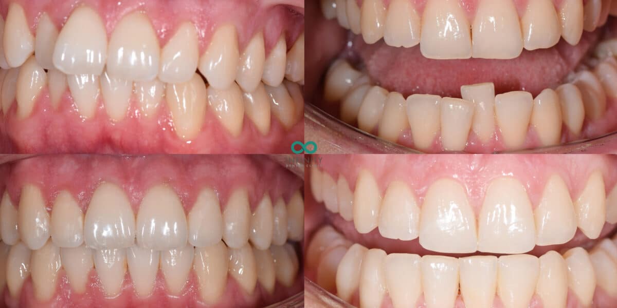Invisalign cases at Infinity Dental Clinic 2