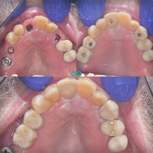 Single implants to replace multiple individual teeth