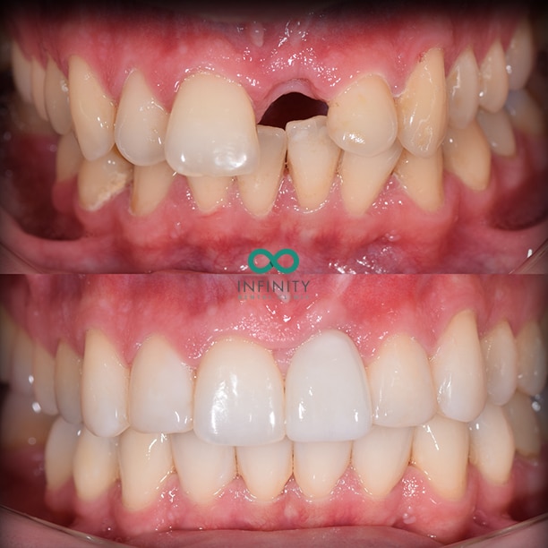 Dental implant UL1 incisor