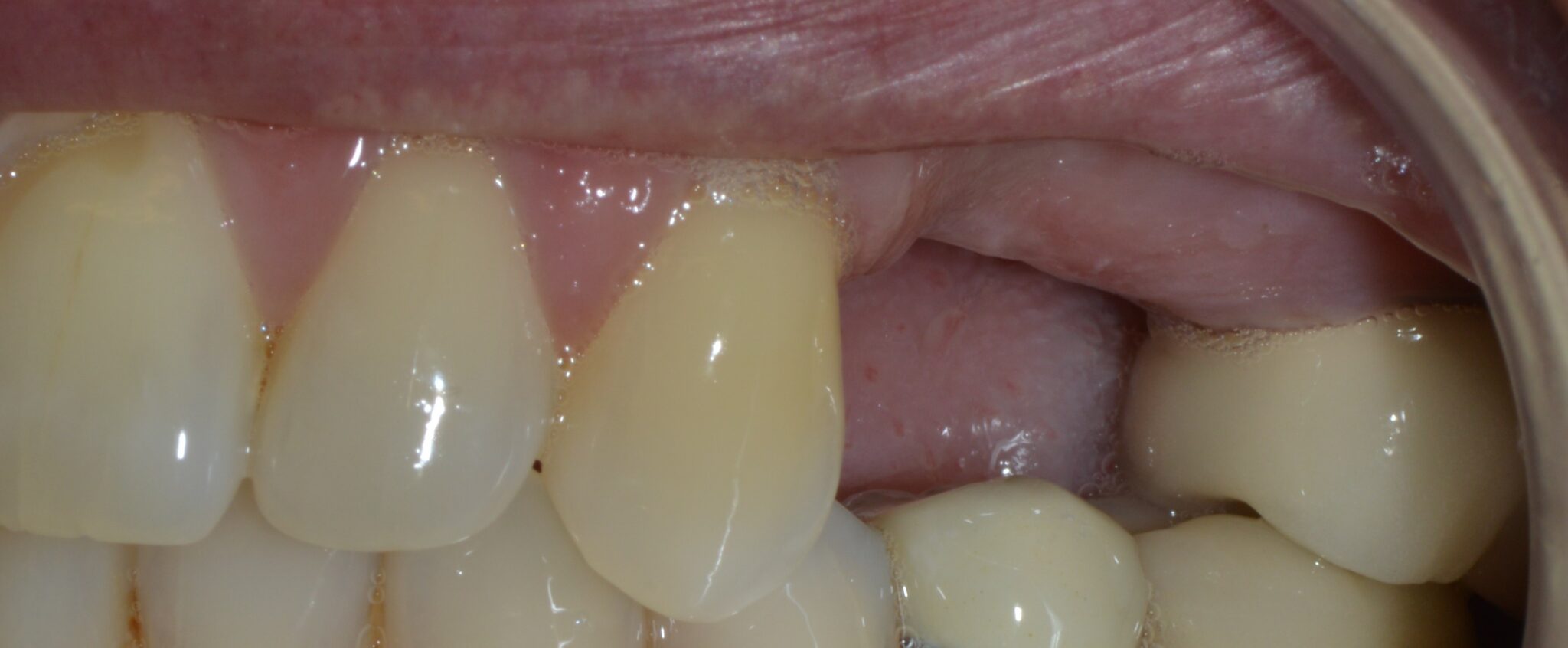 The benefits of replacing missing teeth with a permanent solution ...