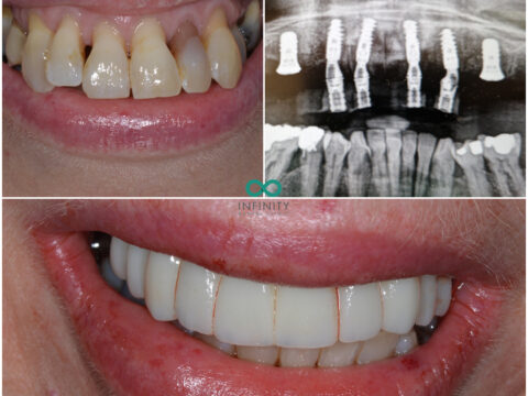 Before and after images of teeth. The top set are discoloured, misaligned and rotten, and with teeth missing. The bottom set are straight and white. There is also an X-Ray showing the dental implants on the top right.