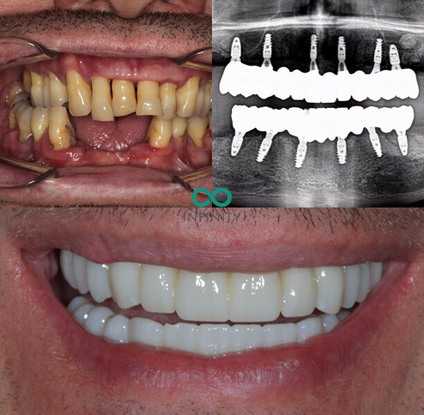 Before and after images of teeth. The top set are discoloured, misaligned, missing and rotten, the bottom set are straight and white. There is also an X-Ray showing the new teeth with implants.
