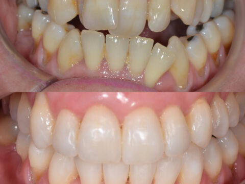 Before and after images of teeth. The top set are discoloured, misaligned and rotten. The bottom set are straight and white.