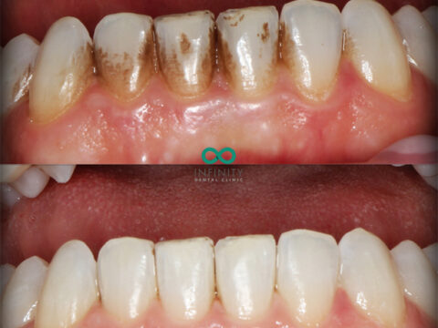 Before and after images of teeth. The top set are discoloured. The bottom set are straight and white.
