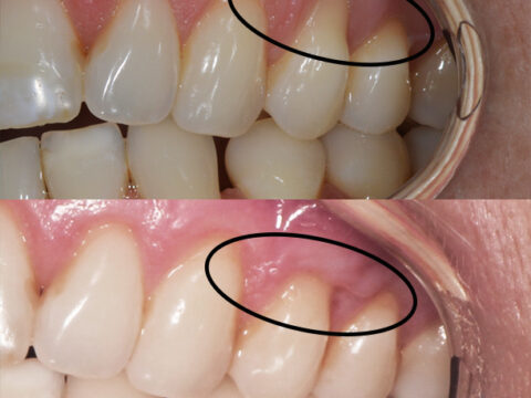 Before and after gum recession treatment with circles showing the repaired area