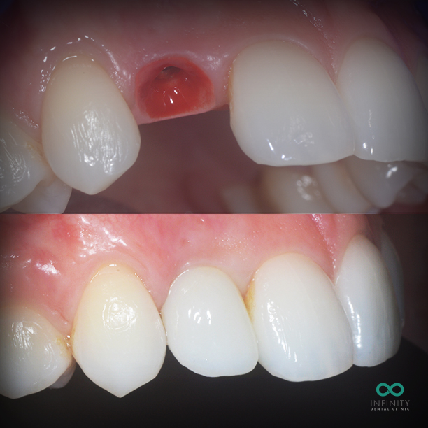 Dental implant to replace upper right lateral incisor