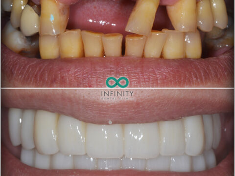 Before and after images of teeth. The top set are discoloured, misaligned and rotten, and with teeth missing. The bottom set are straight and white.