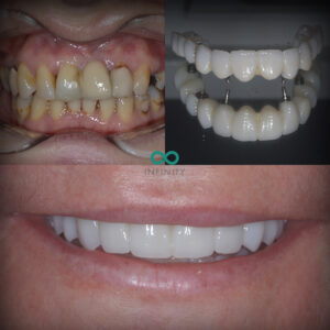 Before and after images of teeth. The top set are discoloured, misaligned and rotten, and with teeth missing. The bottom set are straight and white and show the set of dental implants.