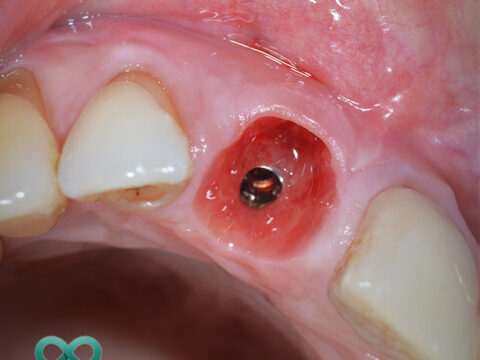 A close up of a hole in a gum, ready for a tooth implantation