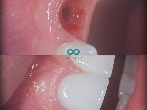 Before and after of a dental implant.