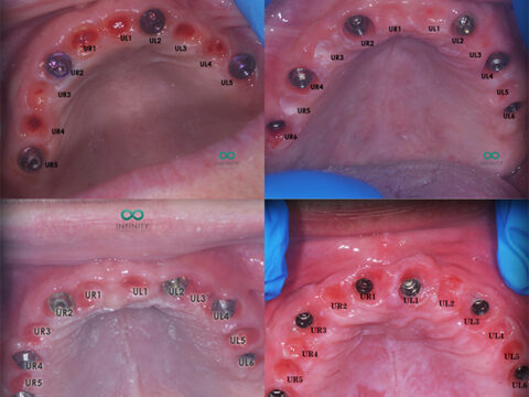 four images of gums that are prepared for a set of implants, they have holes and are numbered.