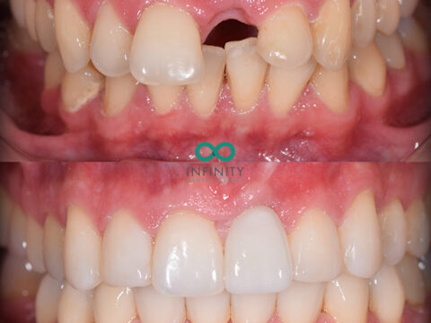Before and after images of teeth. The top set are discoloured, misaligned and with teeth missing. The bottom set are straight and white