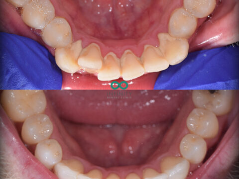Before and after images of teeth. The top set are discoloured and misaligned . The bottom set are straight and white.