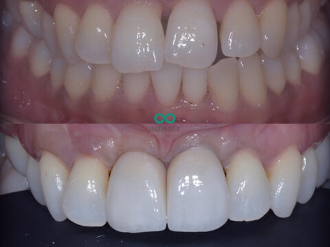 Before and after images of teeth. The top set are discoloured and misaligned. The bottom set are straight and white.