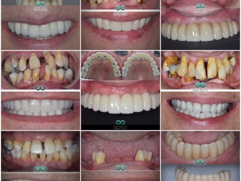 Before and after images of teeth. The top sets are discoloured, misaligned and rotten, and with teeth missing. The bottom sets are straight and white.