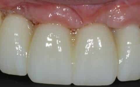 Straight white teeth