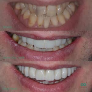 full arch same day teeth dental implants showing the 3 main stages