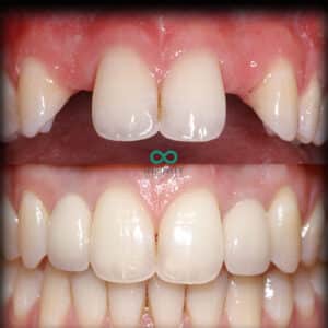 Dental implants for missing teeth hypodontia