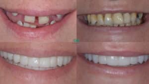 life changing treatment with dental implants