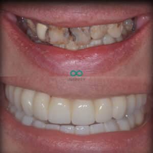 Dental implant life changing treatment