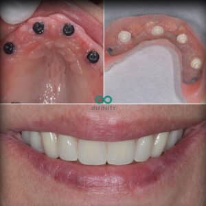 how implant retained dentures fit