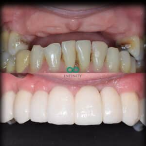 Dental implant supported permanent bridge